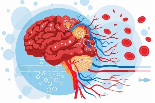 Illustration. Le cerveau et l'AVC.