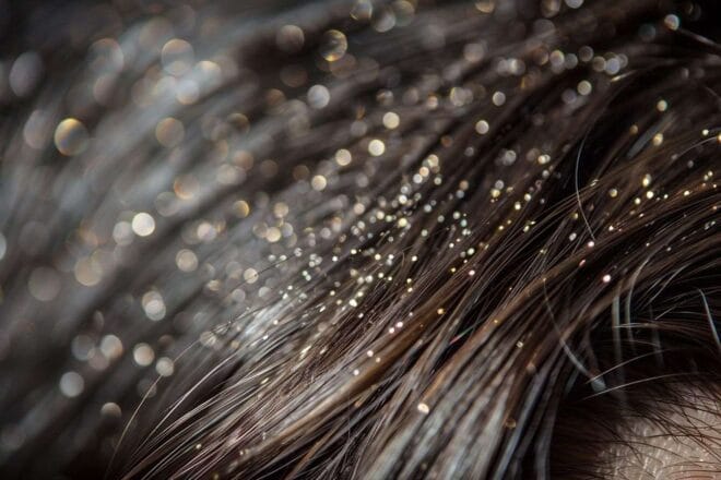 Image d'illustration. Gros plan de mèches de cheveux avec des pellicules visibles