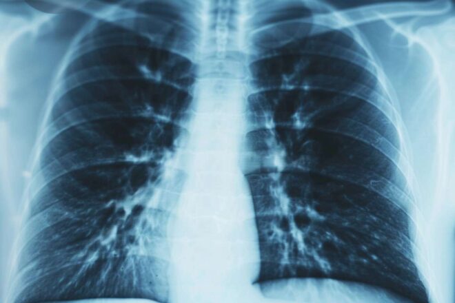 Radiographie poumons