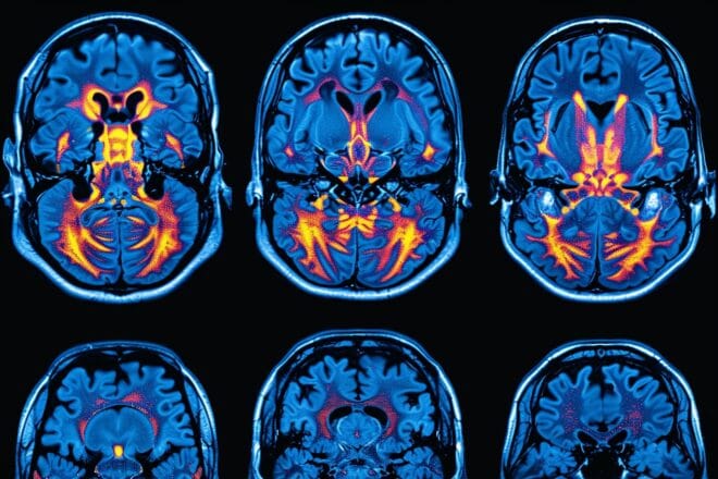 Illustration. Des scintigraphies cérébrales montrent une détérioration progressive due à la maladie d'Alzheimer
