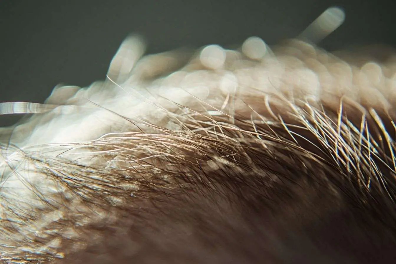 Cette image est un gros plan d'un cuir chevelu avec des mèches de cheveux fines, éclairées par une lumière naturelle douce.